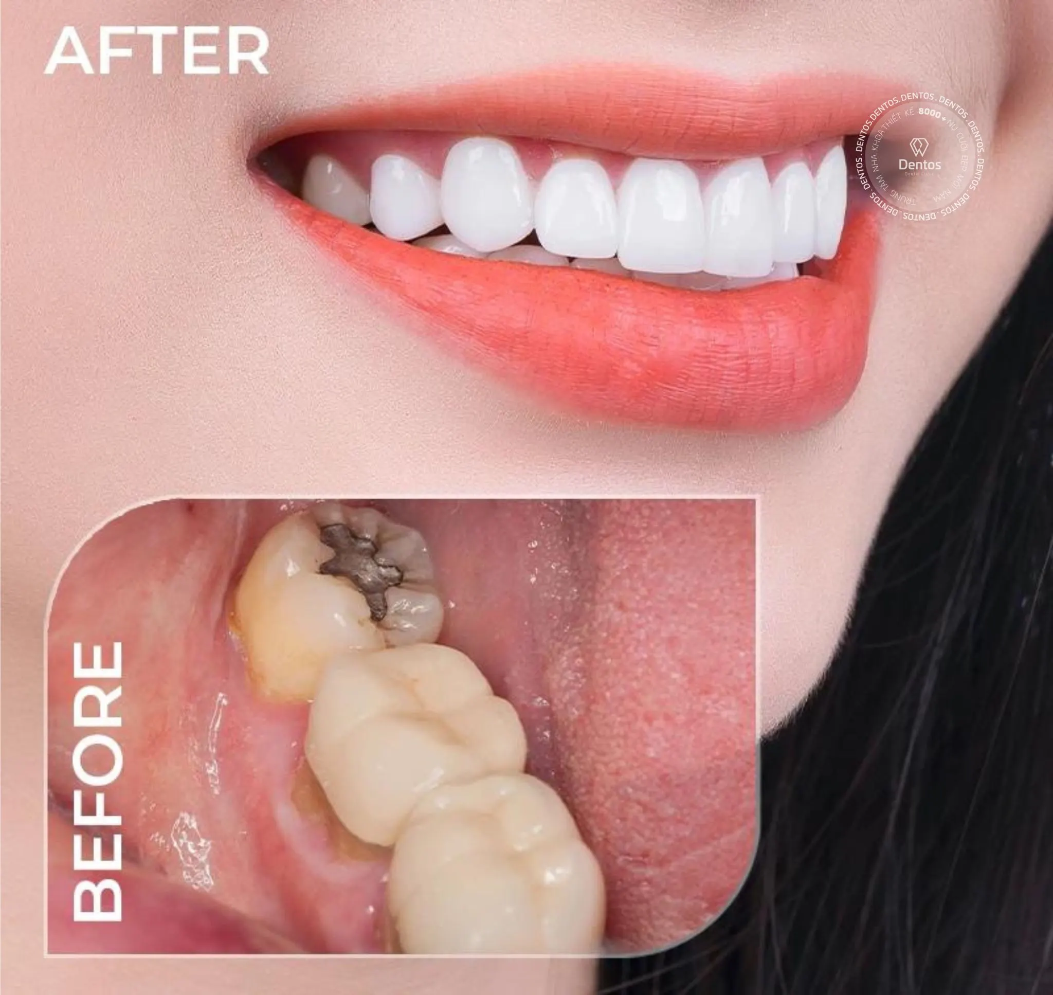 Điều trị tủy răng để bọc răng sứ thẩm mỹ